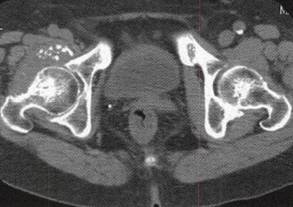 【病例】右髋关节滑膜骨软骨瘤病1例 【病例】右髋关节滑膜骨软骨瘤病1例