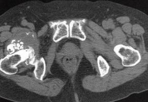 【病例】右髋关节滑膜骨软骨瘤病1例 【病例】右髋关节滑膜骨软骨瘤病1例