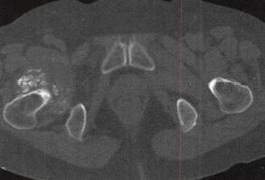【病例】右髋关节滑膜骨软骨瘤病1例 【病例】右髋关节滑膜骨软骨瘤病1例