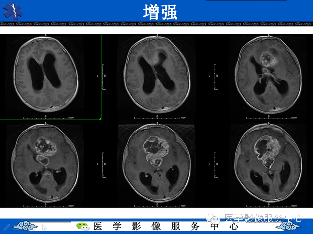 【病例】鞍区毛细胞型星形细胞瘤1例MR