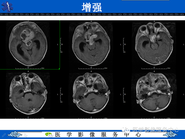 【病例】鞍区毛细胞型星形细胞瘤1例MR