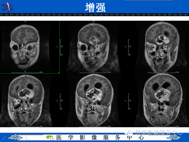 【病例】鞍区毛细胞型星形细胞瘤1例MR