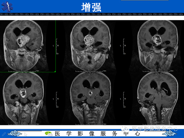 【病例】鞍区毛细胞型星形细胞瘤1例MR