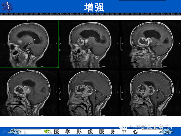 【病例】鞍区毛细胞型星形细胞瘤1例MR