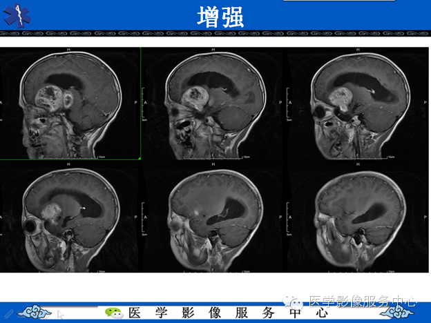 【病例】鞍区毛细胞型星形细胞瘤1例MR