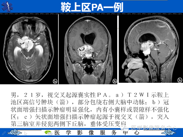 【病例】鞍区毛细胞型星形细胞瘤1例MR