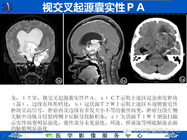 【病例】鞍区毛细胞型星形细胞瘤1例MR