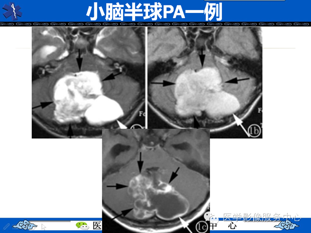【病例】鞍区毛细胞型星形细胞瘤1例MR