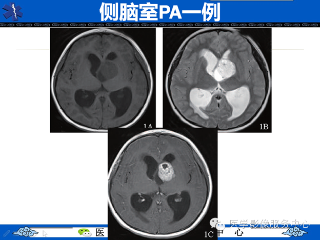 【病例】鞍区毛细胞型星形细胞瘤1例MR
