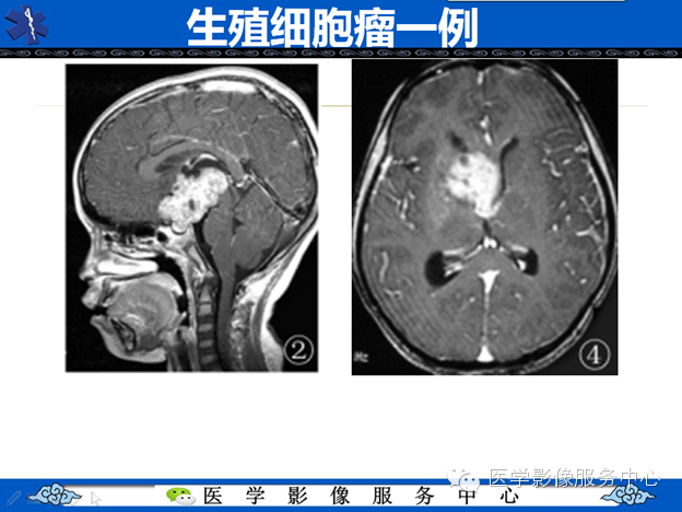 【病例】鞍区毛细胞型星形细胞瘤1例MR
