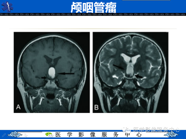 【病例】鞍区毛细胞型星形细胞瘤1例MR