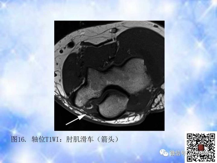 【PPT】肘关节磁共振正常解剖及假性病变