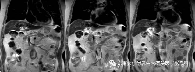 【病例】肝脏炎性肌纤维母细胞瘤1例MR