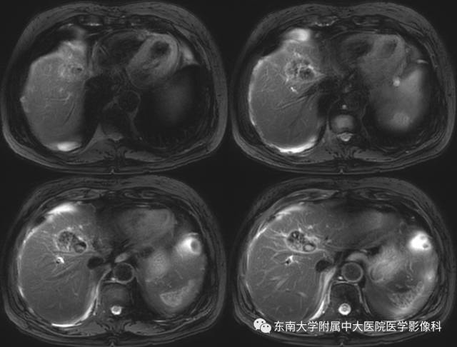 【病例】肝脏炎性肌纤维母细胞瘤1例MR
