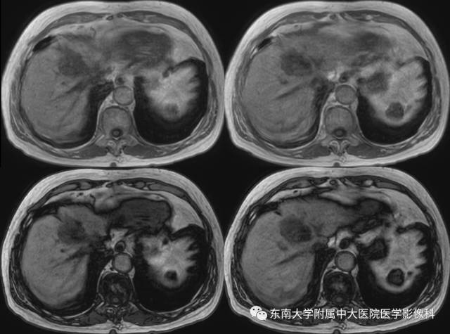 【病例】肝脏炎性肌纤维母细胞瘤1例MR