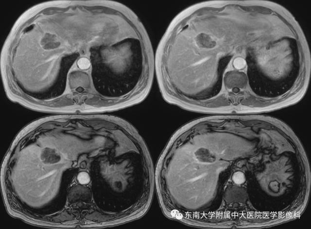 【病例】肝脏炎性肌纤维母细胞瘤1例MR
