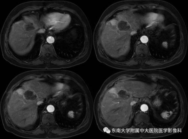 【病例】肝脏炎性肌纤维母细胞瘤1例MR