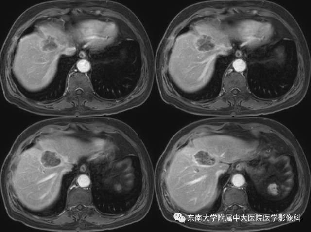 【病例】肝脏炎性肌纤维母细胞瘤1例MR