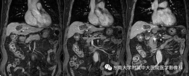 【病例】肝脏炎性肌纤维母细胞瘤1例MR