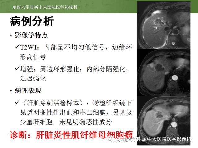 【病例】肝脏炎性肌纤维母细胞瘤1例MR