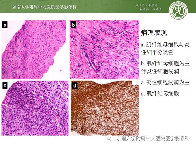 【病例】肝脏炎性肌纤维母细胞瘤1例MR