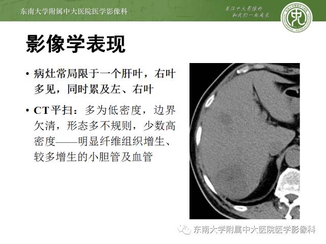 【病例】肝脏炎性肌纤维母细胞瘤1例MR