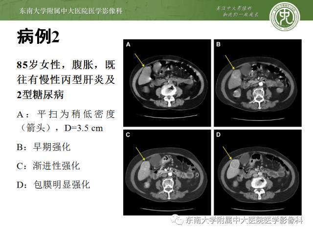 【病例】肝脏炎性肌纤维母细胞瘤1例MR