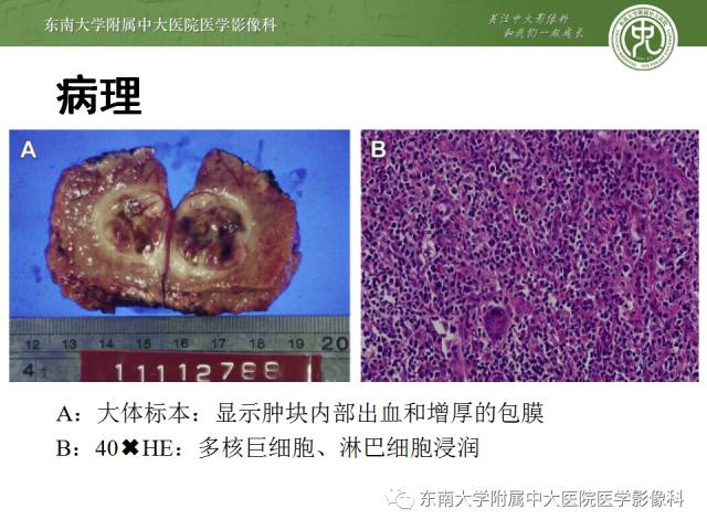 【病例】肝脏炎性肌纤维母细胞瘤1例MR