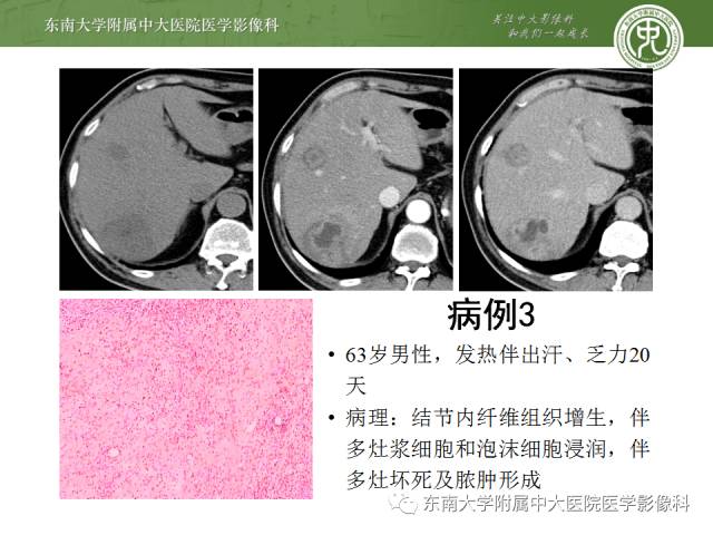 【病例】肝脏炎性肌纤维母细胞瘤1例MR