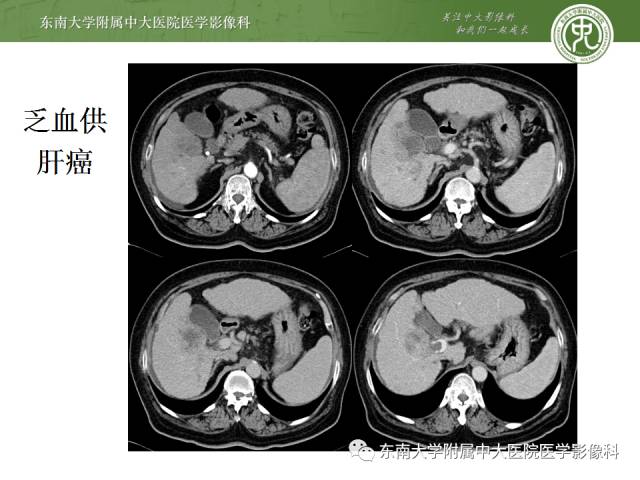 【病例】肝脏炎性肌纤维母细胞瘤1例MR