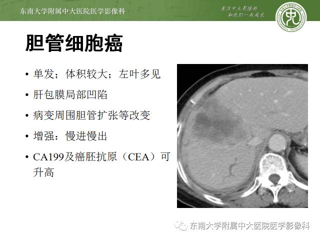 【病例】肝脏炎性肌纤维母细胞瘤1例MR