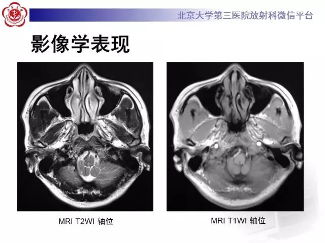 【病例】舌下神经鞘瘤2例MR影像表现