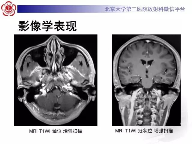 【病例】舌下神经鞘瘤2例MR影像表现