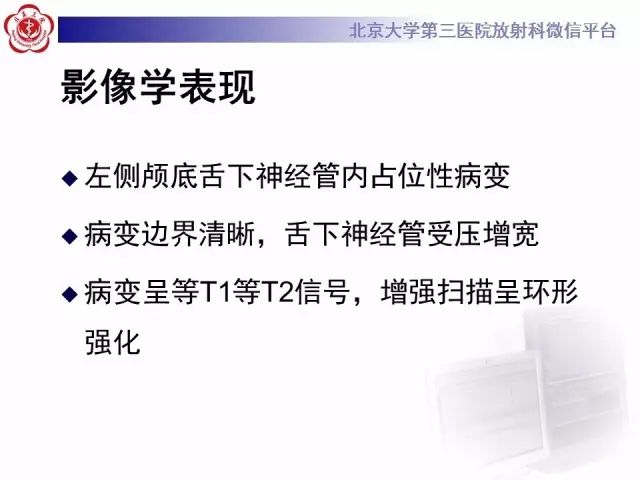 【病例】舌下神经鞘瘤2例MR影像表现