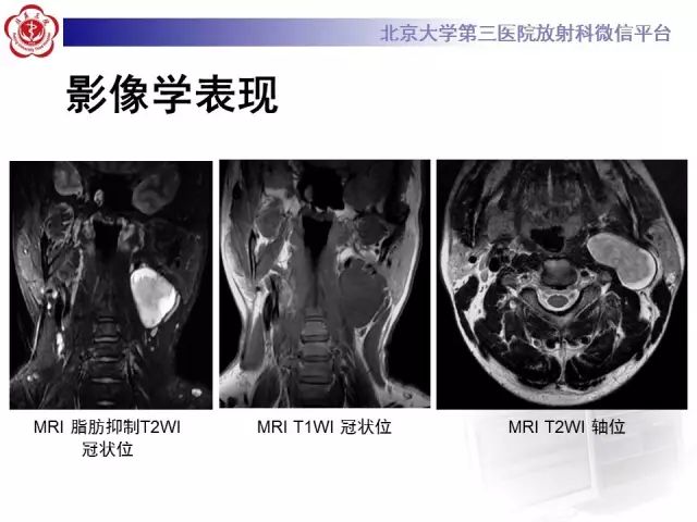 【病例】舌下神经鞘瘤2例MR影像表现