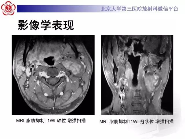 【病例】舌下神经鞘瘤2例MR影像表现