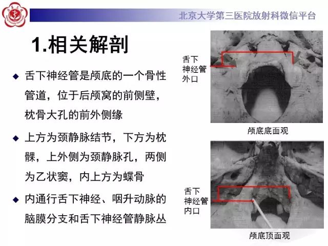 【病例】舌下神经鞘瘤2例MR影像表现