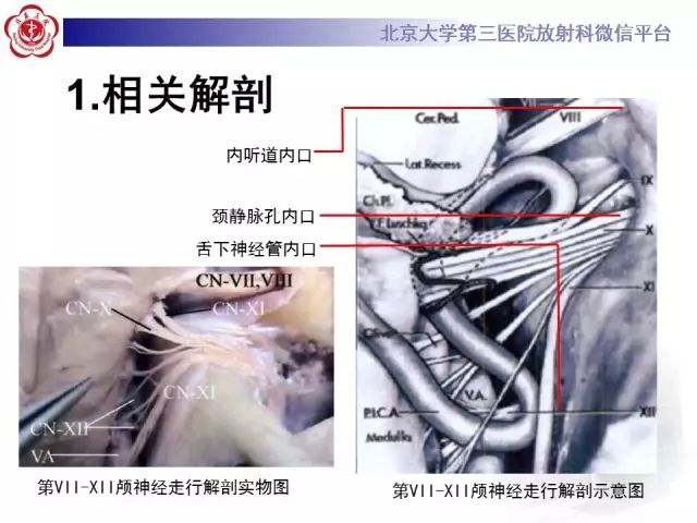 【病例】舌下神经鞘瘤2例MR影像表现