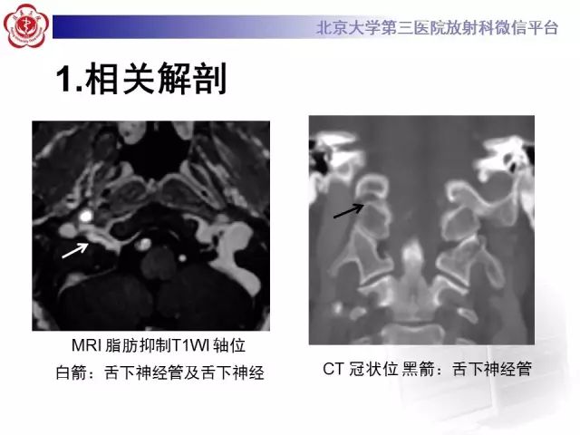 【病例】舌下神经鞘瘤2例MR影像表现