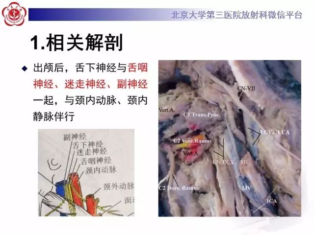 【病例】舌下神经鞘瘤2例MR影像表现