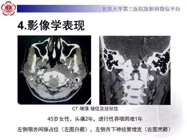 【病例】舌下神经鞘瘤2例MR影像表现