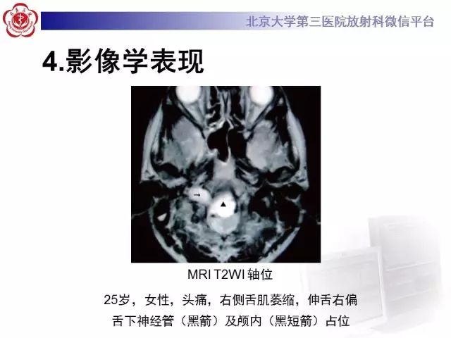【病例】舌下神经鞘瘤2例MR影像表现
