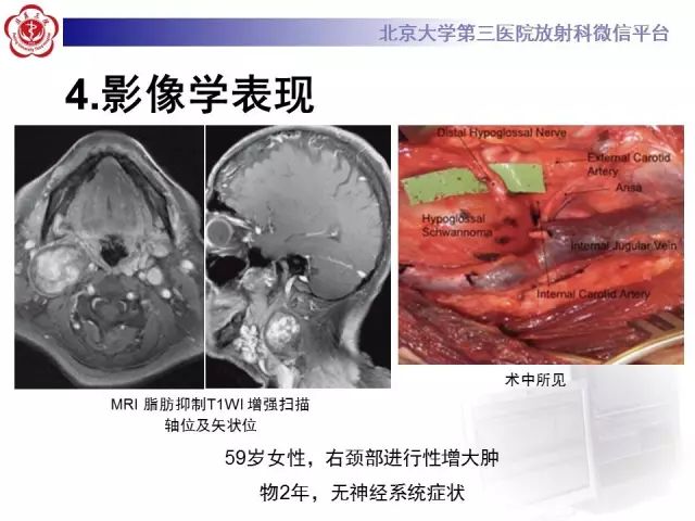 【病例】舌下神经鞘瘤2例MR影像表现