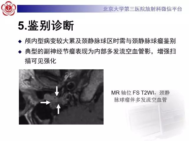 【病例】舌下神经鞘瘤2例MR影像表现