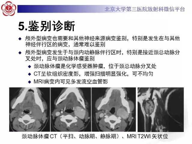 【病例】舌下神经鞘瘤2例MR影像表现