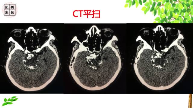 【病例】颅底软骨肉瘤1例CT及MR影像诊断思路