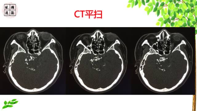 【病例】颅底软骨肉瘤1例CT及MR影像诊断思路