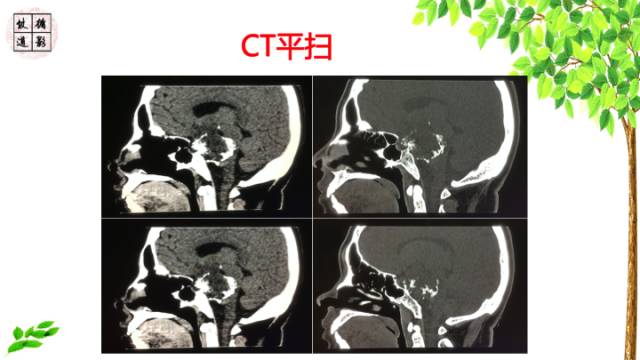 【病例】颅底软骨肉瘤1例CT及MR影像诊断思路