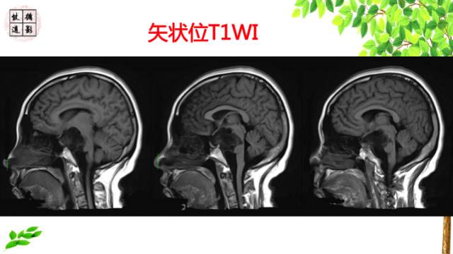 【病例】颅底软骨肉瘤1例CT及MR影像诊断思路