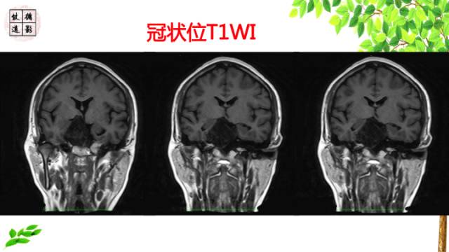 【病例】颅底软骨肉瘤1例CT及MR影像诊断思路